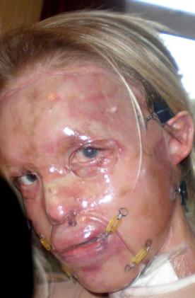 Η 30χρονη καλλονή που δεν το έβαλε κάτω: Στα 24 τής κατέστρεψαν το πρόσωπο με οξύ -Σήμερα είναι παρουσιάστρια εκπομπής [εικόνες]