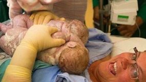 Δείτε τη μαμά  που έβγαλε με τα ίδια της τα χέρια από τη κοιλιά   τα δίδυμα μωρά της κατά τη διάρκεια της καισαρικής τομής! (βίντεο)
