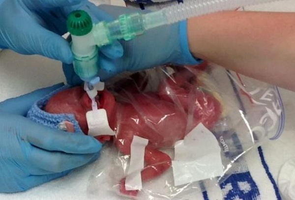 Έσωσαν τη ζωή ενός πρόωρου μωρού 450γρ. με ένα… σακουλάκι τροφίμων!