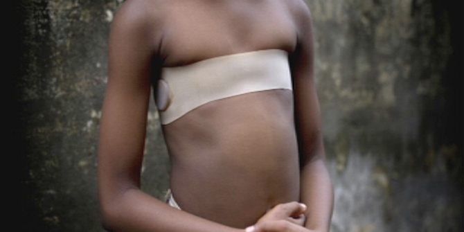 Σιδερώνουν το στήθος  κοριτσιών για να αποφύγουν τον βιασμό