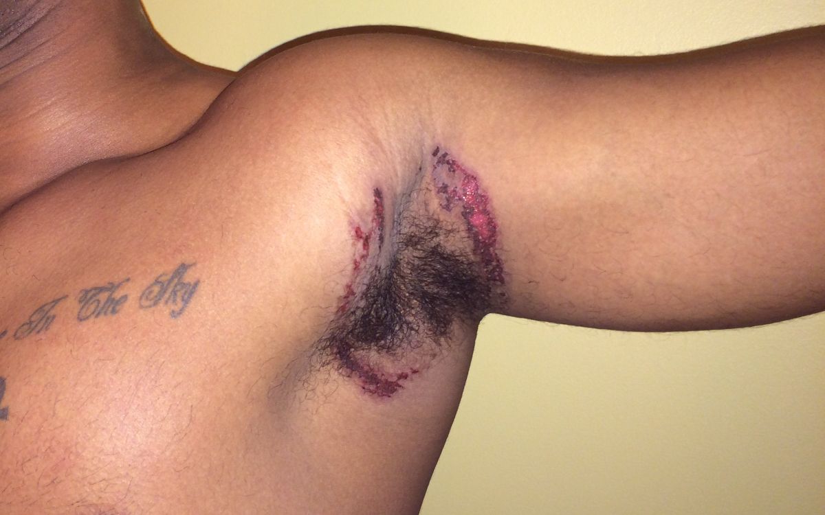 Γνωστό αποσμητικό δημιούργησε έγκαυμα στην μασχάλη του! ΒΙΝΤΕΟ