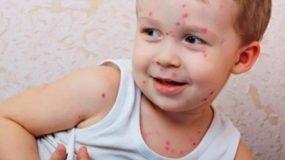 Παιδικές ασθένειες:Ανεμοβλογιά