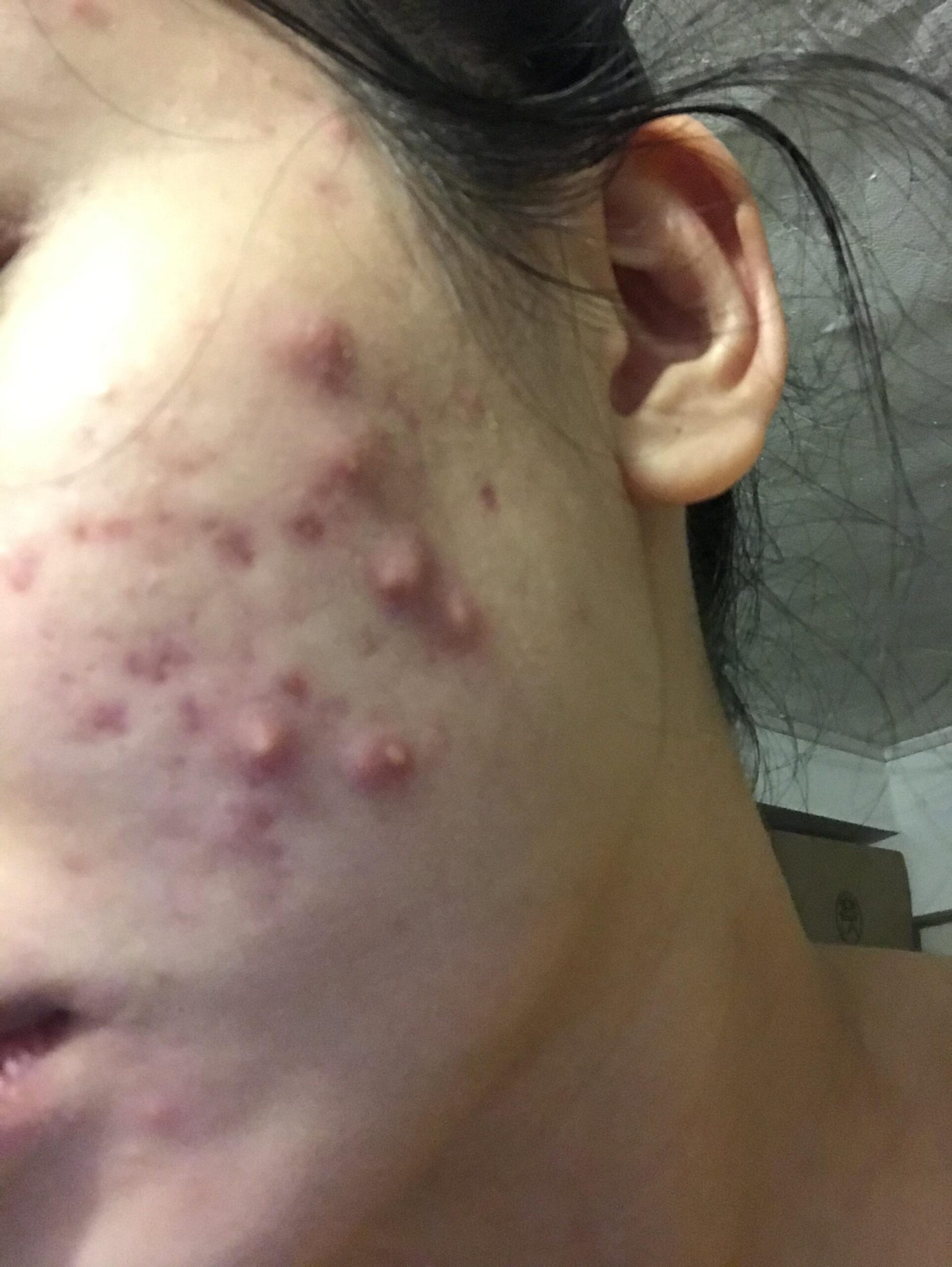 ακμή-μεγάλα-σπυράκια