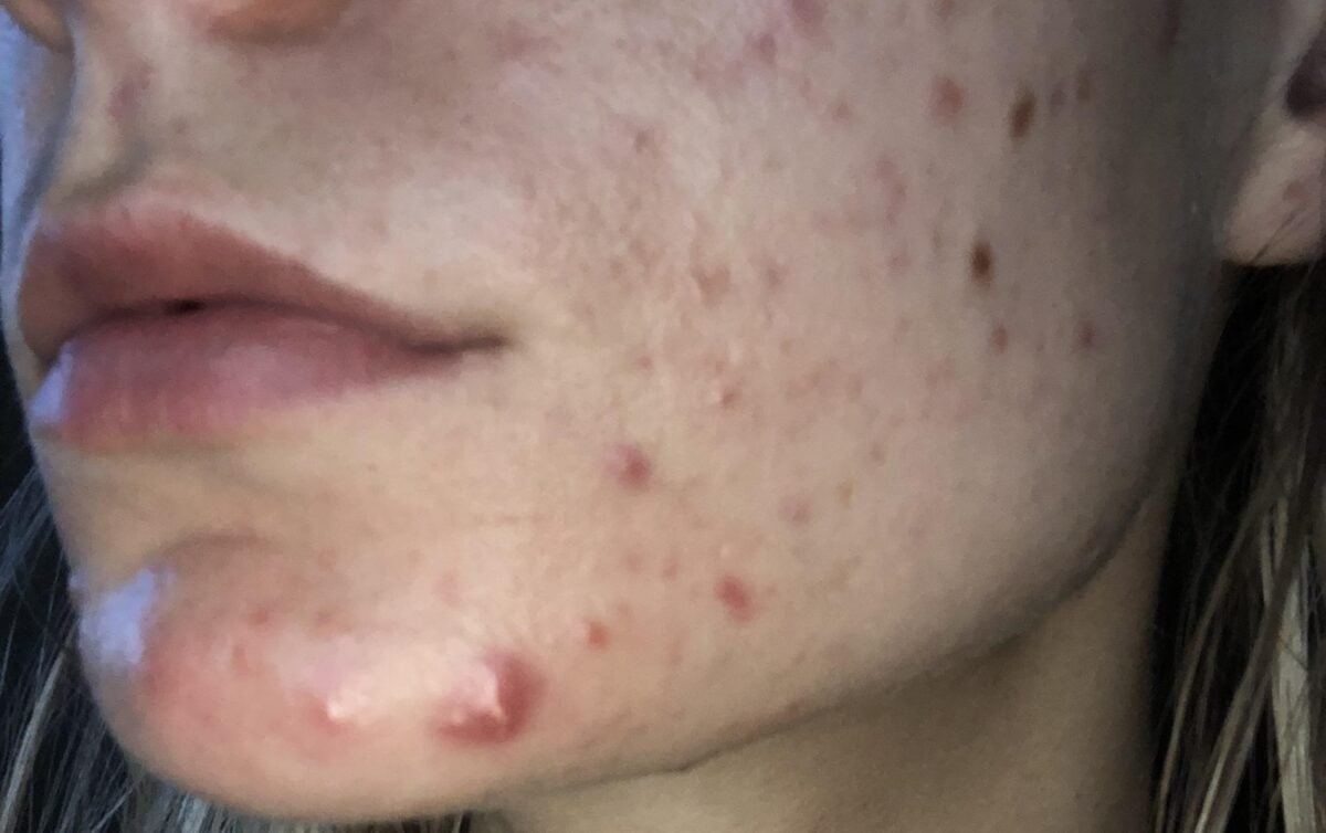 Δες αν έχεις ορμονολογικές διαταραχές τσεκάροντας τα παρακάτω συμπτώματα