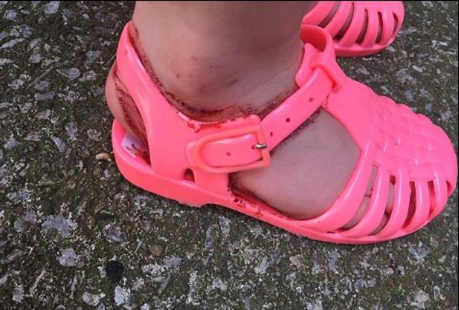 Δείτε τι έπαθαν τα πόδια 2χρονης από γνωστής μάρκας σανδάλια που φόρεσε - Σκληρές εικόνες