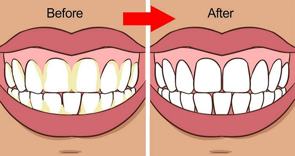7 φυσικοί τρόποι για να καταπολεμήσετε την πλάκα και την πέτρα στα δόντια