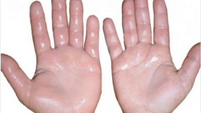 6 σπιτικές θεραπείες για πρησμένα χέρια