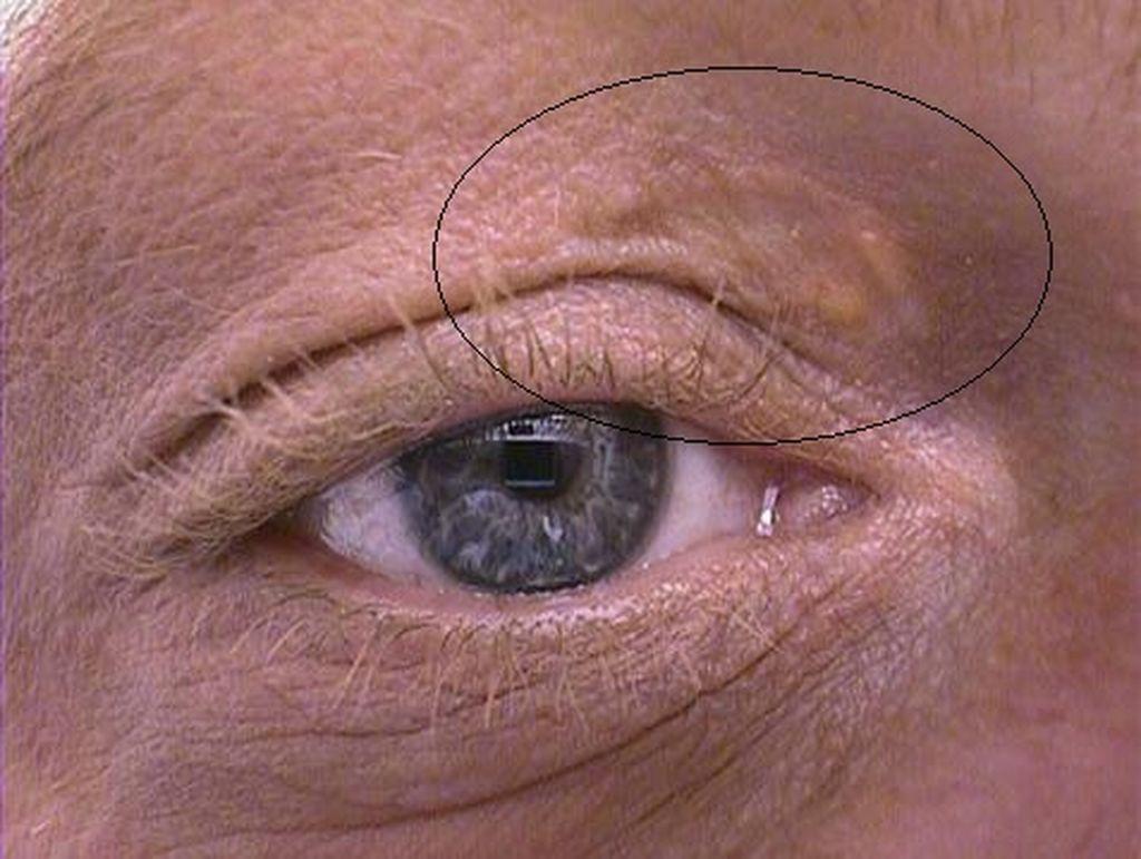 Τα σημάδια της υψηλής χοληστερίνης που δεν πρέπει να αγνοήσουμε