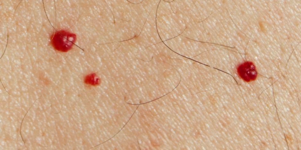 Τι προκαλεί τα κόκκινα σημάδια στο δέρμα σας;