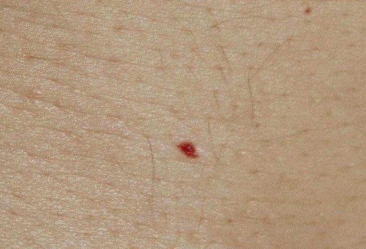 Τι προκαλεί τα κόκκινα σημάδια στο δέρμα σας;