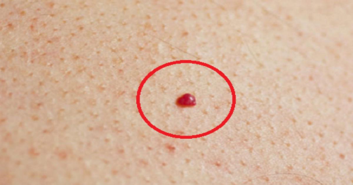 Τι προκαλεί τα κόκκινα σημάδια στο δέρμα σας;