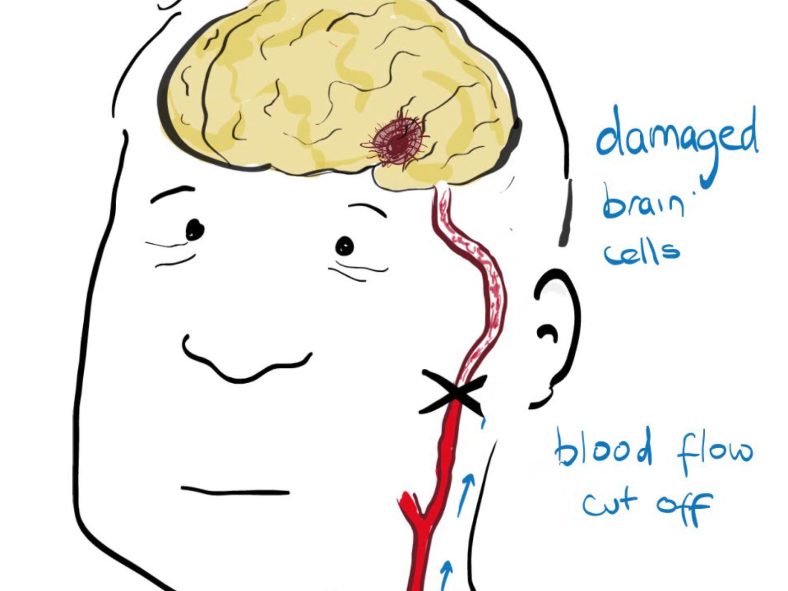 Εγκεφαλικό επεισόδιο: 6 κοινά σημάδια που σας προειδοποιούν