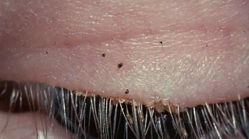 pestanas-piojos-500x280