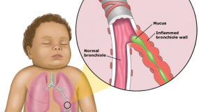 Λοίμωξη των βρεφών από τον Αναπνευστικό Συγκυτιακό Ιό (RSV)