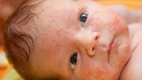 Ακμή στα μωρά: αιτίες, συμπτώματα και θεραπεία