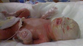 Μωρό γεννήθηκε καλυμμένο με άσπρα λέπια στο δέρμα του, 5 χρόνια αργότερα, οι γιατροί δεν είχαν ξαναδεί ποτέ έναν τέτοιο πρόσωπο