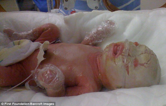 Μωρό γεννήθηκε καλυμμένο με άσπρα λέπια στο δέρμα του, 5 χρόνια αργότερα, οι γιατροί δεν είχαν ξαναδεί ποτέ έναν τέτοιο πρόσωπο
