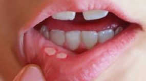 Υγεία: Αίτια, συμπτώματα και αντιμετώπιση για τις άφθες στο στόμα