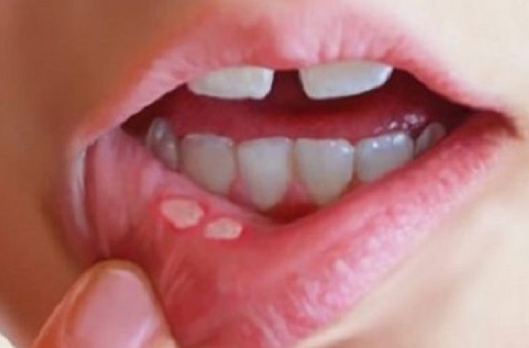 Υγεία: Αίτια, συμπτώματα και αντιμετώπιση για τις άφθες στο στόμα