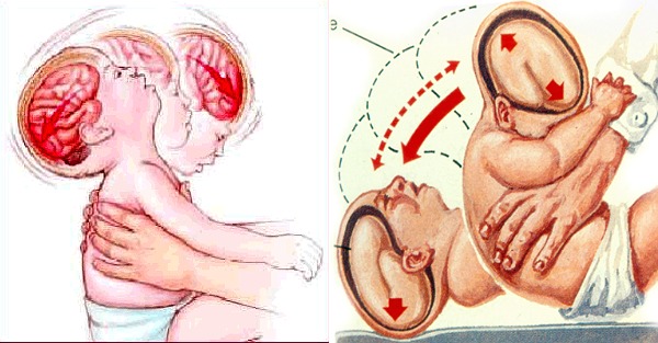 Σύνδρομο της ανατάραξης του μωρού: Τι είναι, ποιες οι ολέθριες συνέπειες στον εγκέφαλό του
