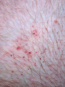 Μήπως αναρωτιέστε τι τσίμπησε το παιδί; Δείτε 12 διαφορετικά τσιμπήματα από έντομα..