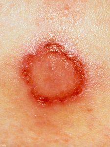 Μήπως αναρωτιέστε τι τσίμπησε το παιδί; Δείτε 12 διαφορετικά τσιμπήματα από έντομα..