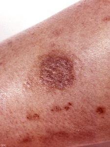 Μήπως αναρωτιέστε τι τσίμπησε το παιδί; Δείτε 12 διαφορετικά τσιμπήματα από έντομα..