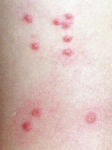 Μήπως αναρωτιέστε τι τσίμπησε το παιδί; Δείτε 12 διαφορετικά τσιμπήματα από έντομα..