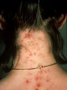 Μήπως αναρωτιέστε τι τσίμπησε το παιδί; Δείτε 12 διαφορετικά τσιμπήματα από έντομα..