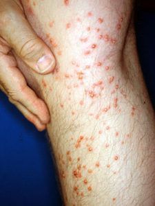 Μήπως αναρωτιέστε τι τσίμπησε το παιδί; Δείτε 12 διαφορετικά τσιμπήματα από έντομα..