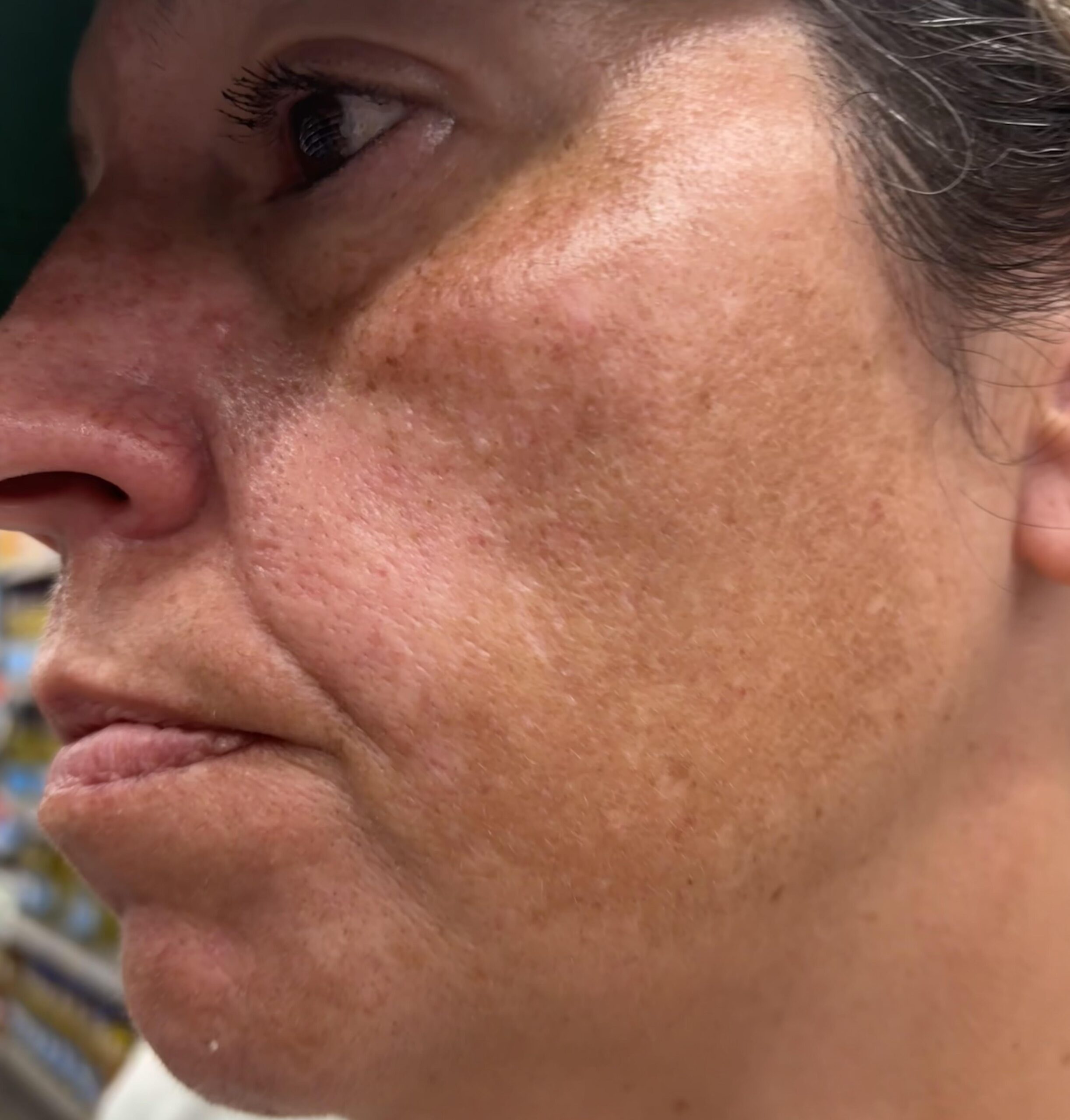 6 Φυσικοί Τρόποι για να Αντιμετωπίσετε τον Αποχρωματισμό του Δέρματος