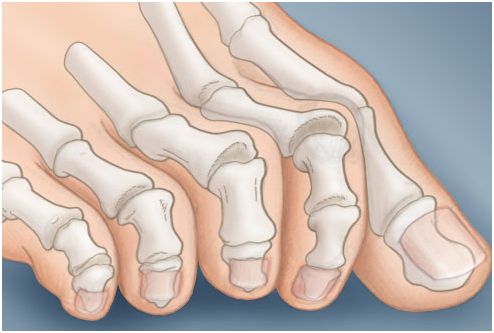 Τα νύχια των ποδιών σας δείχνουν αν κινδυνεύετε από ΚΑΡΚΙΝΟ
