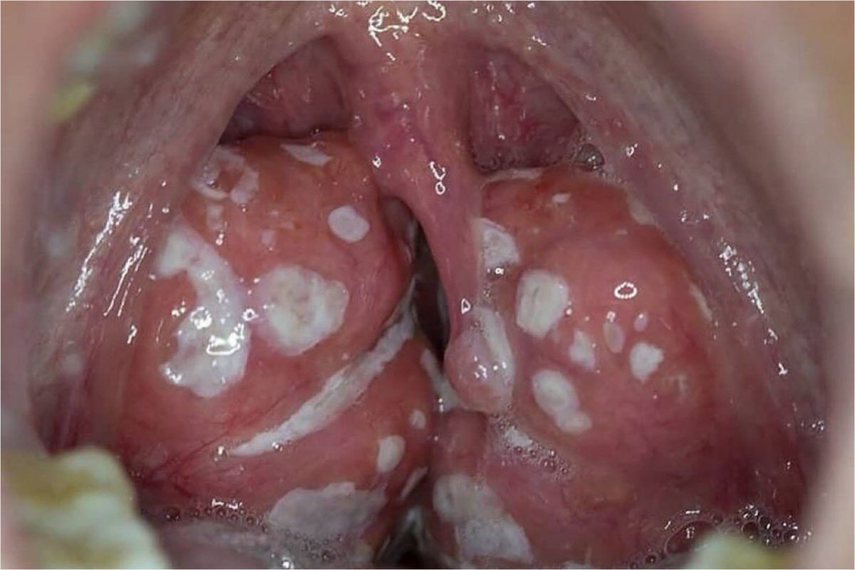 Tι είναι αυτά τα βρωμέρα λευκά κομματάκια που βγάζεις από το στόμα σου όταν βήχεις;