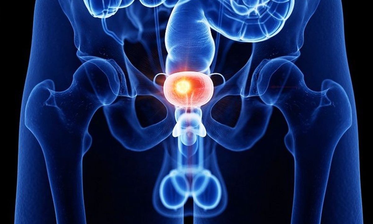 7 συμπτώματα του καρκίνου της ουροδόχου κύστεως που όλοι πρέπει να γνωρίζουμε!