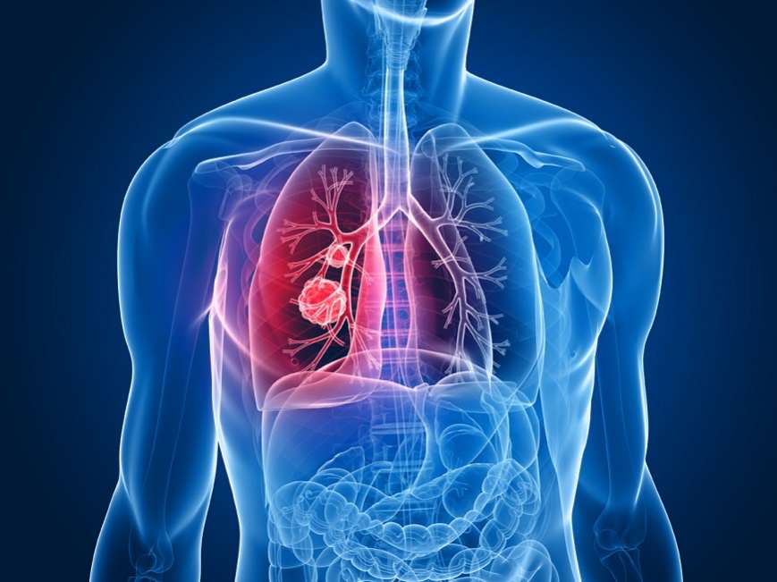 Ο καρκίνος του πνεύμονα είναι πιο θανατηφόρος στις γυναίκες