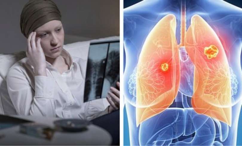 Ο καρκίνος του πνεύμονα είναι πιο θανατηφόρος στις γυναίκες