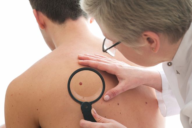Τι πρέπει να προσέξετε για να εντοπίσετε νωρίς τα σημάδια του καρκίνου του δέρματος;