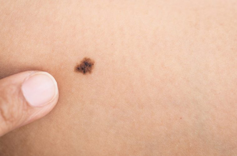 Ελιές στο δέρμα: Αυτά είναι τα 5 σημάδια που δείχνουν κίνδυνο για καρκίνο