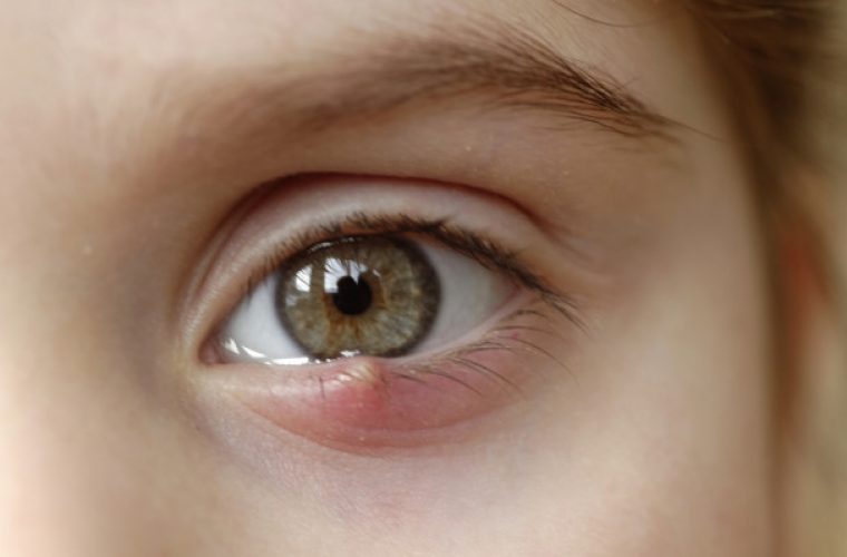 Κριθαράκι στο μάτι: Αίτια, θεραπεία και πρόληψη