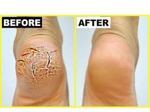 Βάζει αυτό το μείγμα πάνω στις φτέρνες της και το αφήνει εκεί όλο το βράδυ.. Το επόμενη πρωί αυτό που συμβαίνει είναι απίστευο