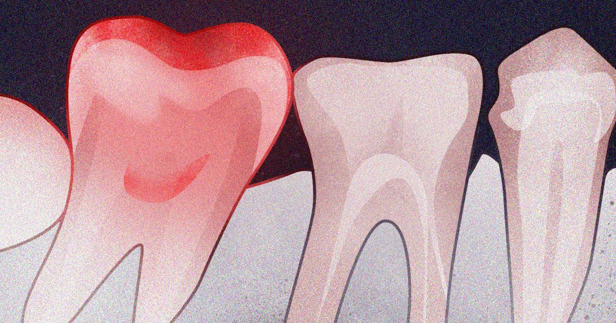 10 σημάδια της τοξικης μολυνσης των δοντιων και πως να τα αντιμετωπίσετε