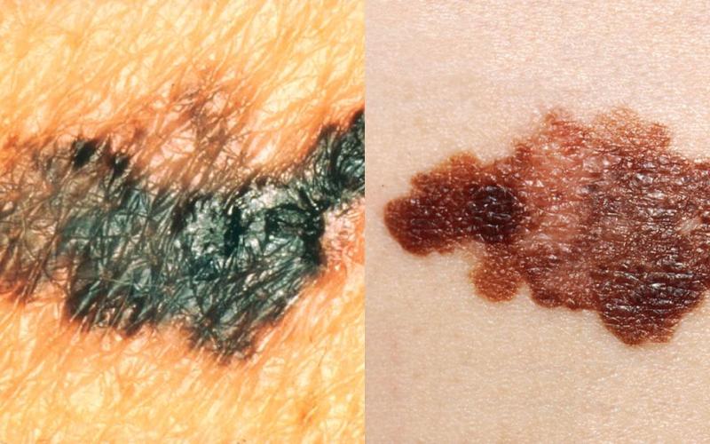 Ο οδηγός αυτός ανίχνευσης του καρκίνου του δέρματος μπορεί να σας σώσει τη ζωή