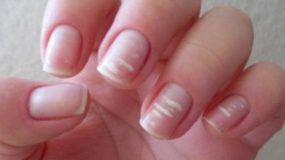 Λευκονυχία: γιατί έχετε λευκά σημάδια στα νύχια σας;