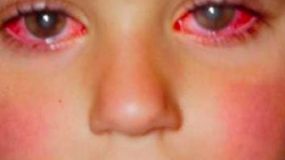 Γονείς ΠΡΟΣΟΧΗ: 8χρονος έχασε την όρασή του από ένα Παιχνίδι που ΟΛΟΙ έχουμε αγοράσει στα Παιδιά μας!
