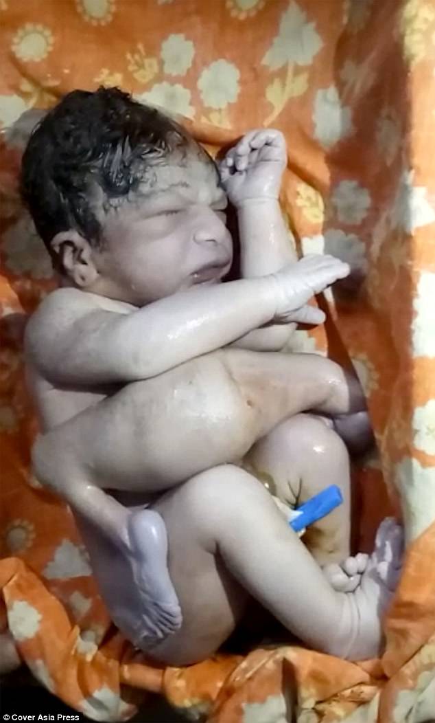 Μωράκι γεννήθηκε με δύο παραπάνω πόδια και πέος αλλά οι γιατροί το έσωσαν