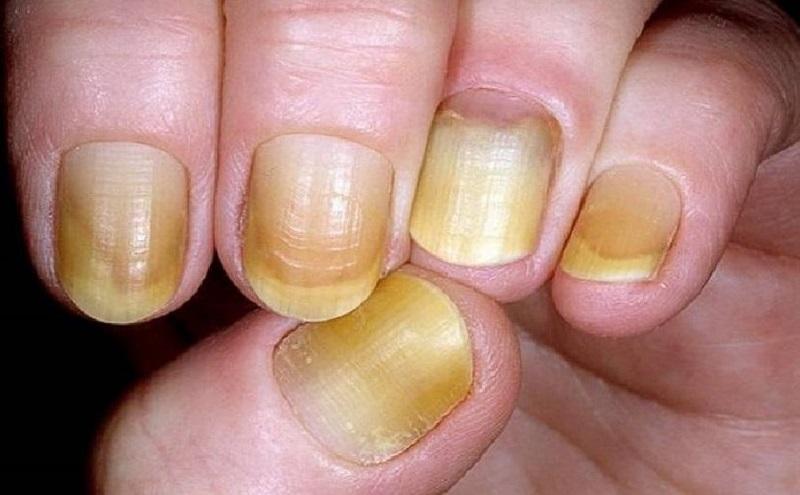 Κίτρινα νύχια: 11 θεραπείες που θα σας σώσουν!