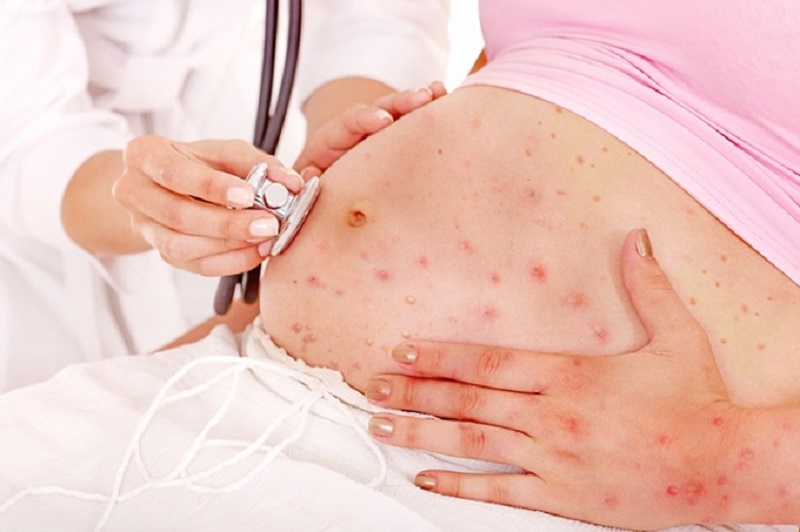 Είμαι έγκυος : Ti γίνεται αν κολλήσω ιλαρά ;