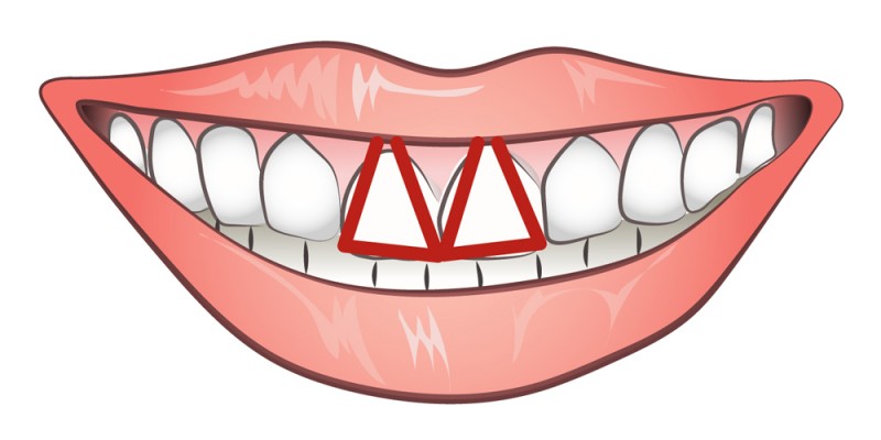 Τι δείχνουν τα δύο μπροστινά δόντια για το χαρακτήρα σας;