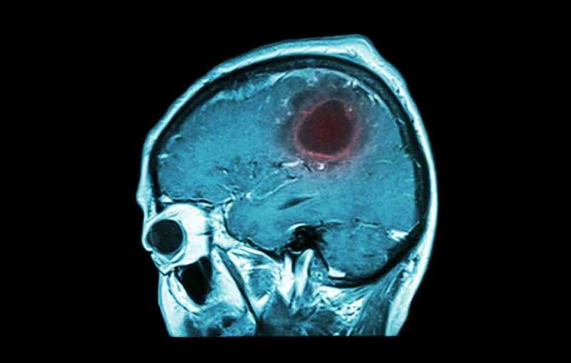 15 σημάδια που δείχνουν οτι μπορεί κάποιος να έχει όγκο στον εγκέφαλο.