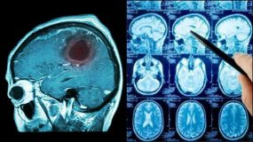 15 σημάδια που δείχνουν οτι μπορεί κάποιος να έχει όγκο στον εγκέφαλο.